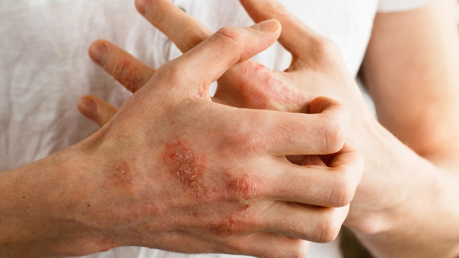 Homeopathy for Psoriasis, Eczema & Seborrhoeic Dermatitis: A Holistic, Evidence-Based Approach