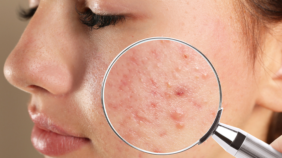 Homeopathy for Pimples and Acne: A Natural, Evidence-Based Approach
